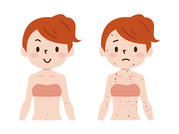 イラスト：身体に赤い斑点ができた女性