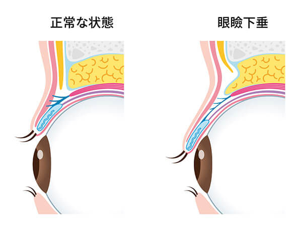 図解：正常な状態と眼瞼下垂
